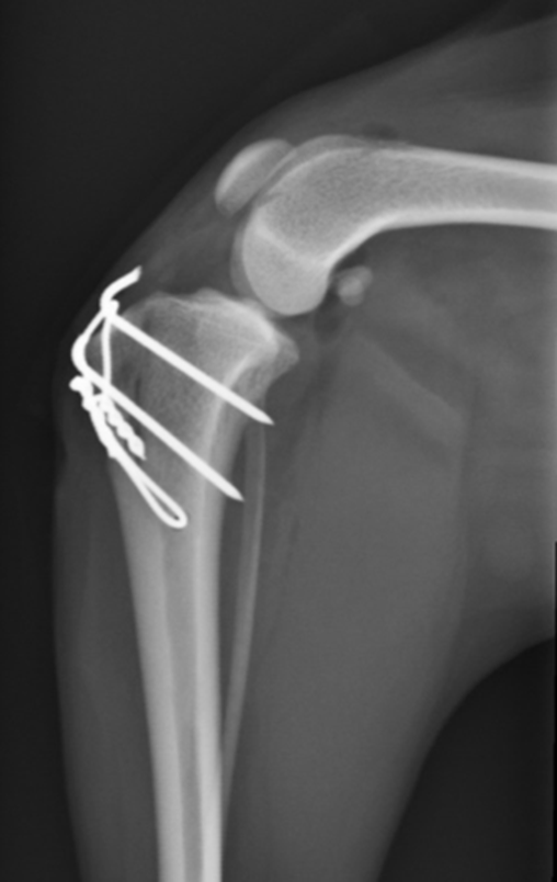 Radiographs showing post operative views of a dog that has had a simple tibial crest transposition