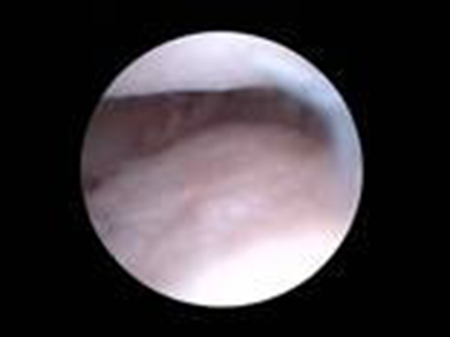 Arthroscopic pictures of the medial coronoid showing just coronoid disease with no fragments a coronoid fragment with little cartilage injury and a coronoid fragment with extensive cartilage disease