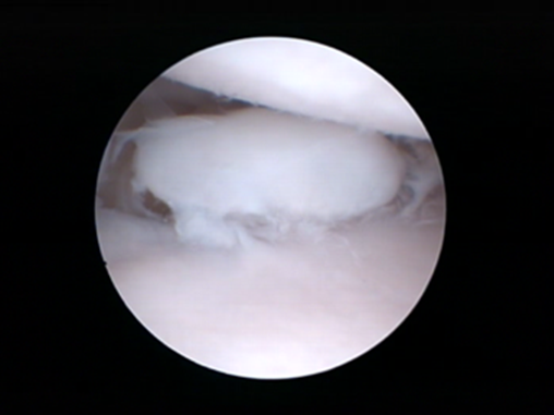 Arthroscopic pictures of the medial coronoid showing just coronoid disease with no fragments a coronoid fragment with little cartilage injury and a coronoid fragment with extensive cartilage disease