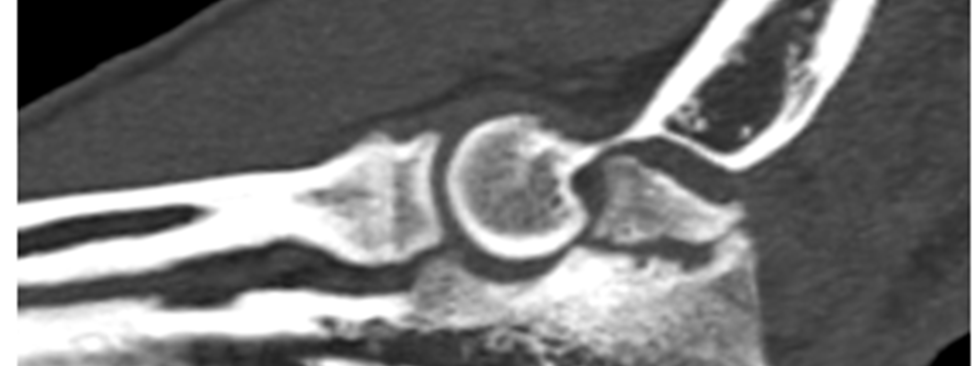 Elbow Ridge Elbow Conditions | Ridge Referrals