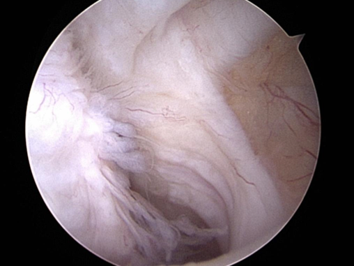 Arthroscopic picture of a biceps tendon injury