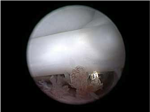 Arthroscopic