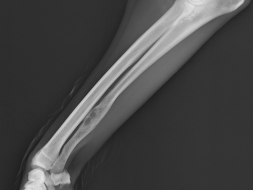 Benign ulna lesion