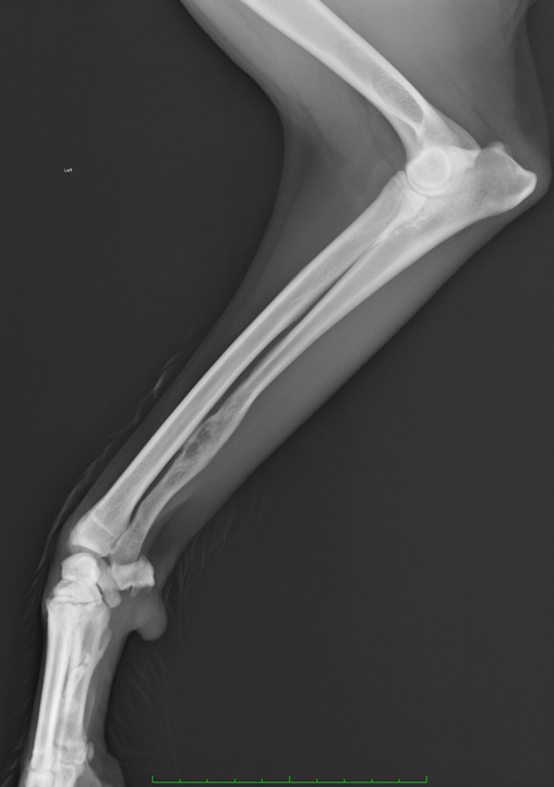 Benign ulna lesion