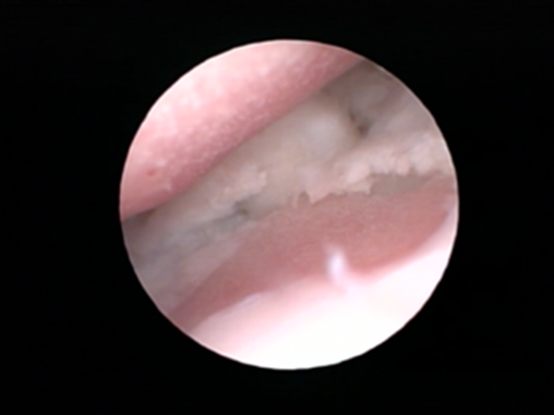 Arthroscopic pictures of the medial coronoid showing just coronoid disease with no fragments a coronoid fragment with little cartilage injury and a coronoid fragment with extensive cartilage disease