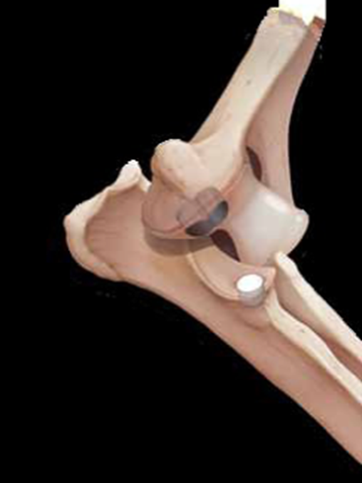 Implants in position in an elbow model
