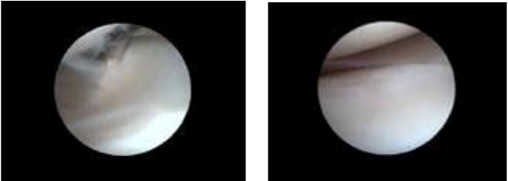 Arthroscopic