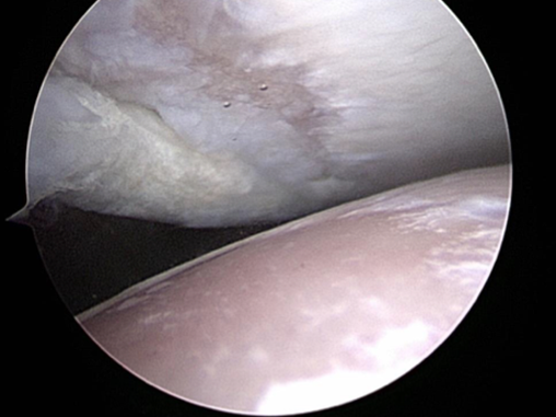 Caudal glenoid fragmentation and cartilage loss