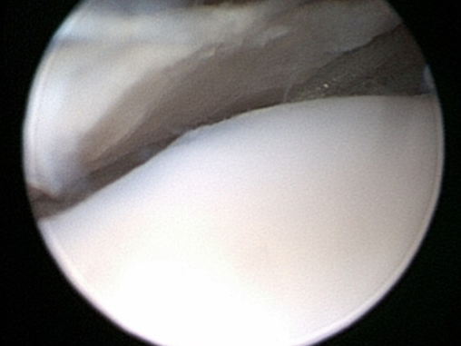 Arthroscopic pictures of an OCD flap in place