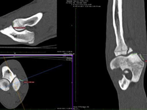 CT Image of Elbow